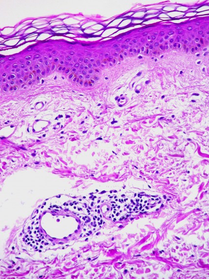 Clínica Dermitek, casos de estudio de urticaria por depilación láser